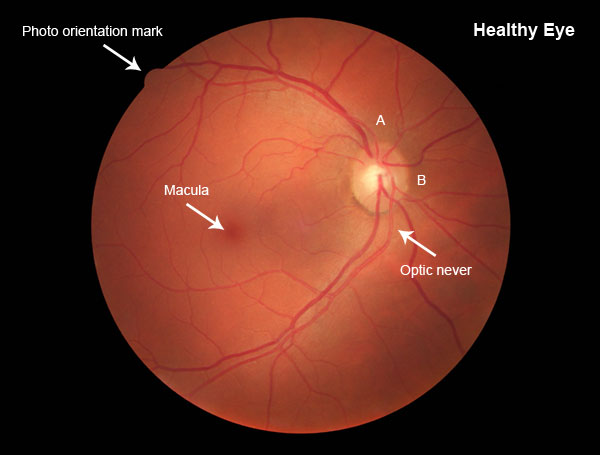 healthy eye
