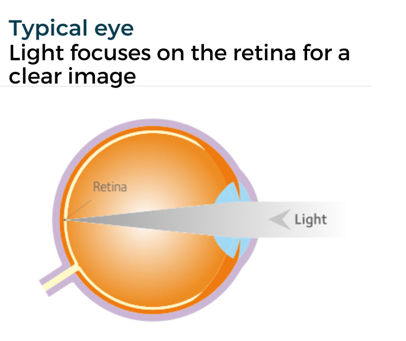 typical eye